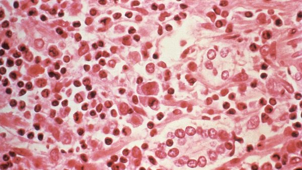 Moderna inicia desarrollo de vacuna contra hantavirus tras brote en crucero